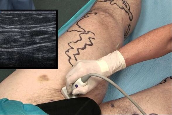 vyrų varikozinių venų diagnozė