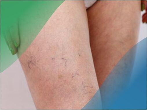Kraujagyslių tinklas ant kojų yra vienas iš venų varikozės simptomų