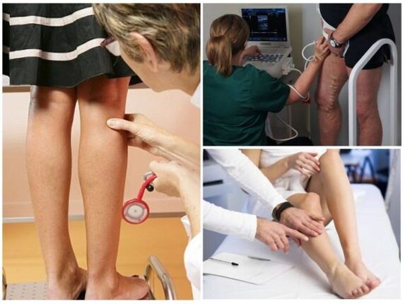 Varikozės venų diagnozė