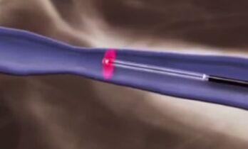 Šiluminės procedūros